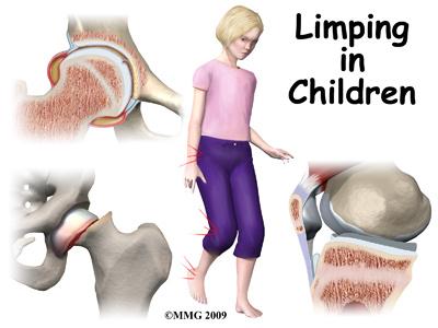 Introduction Limping in a child is a concern. Limping in a child is never normal. It can be caused by many things, sometimes by something minor, like a blister or cut.
