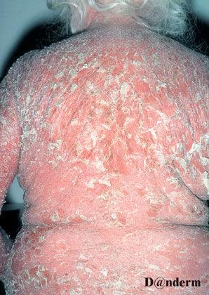Emergency Dermatology Erythroderma Erythroderma ( red skin ) Exfoliative dermatitis involving at least 90% of the skin surface Causes Previous skin disease (e.g. eczema, psoriasis), lymphoma, drugs (e.