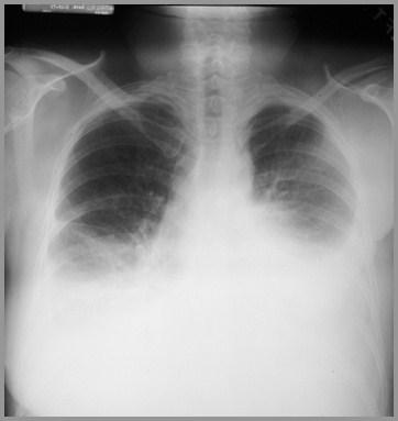 Pulmonary SLE may lead to multiple pulmonary complications such as pleurisy, pleural effusion, DPLD, pneumonitis, pulmonary