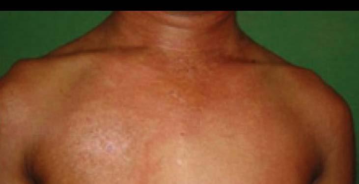 Male presented with -Fever for 15 days -Erythomatous rash involving chest for same