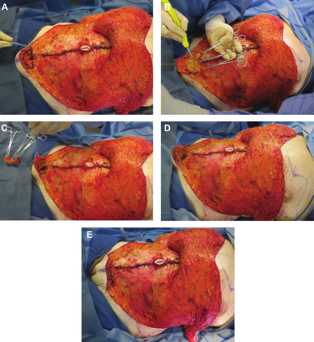 Bloom et al 879 Figure 1. (A) A wedge resection of adipose tissue is planned after completion of rectus plication.