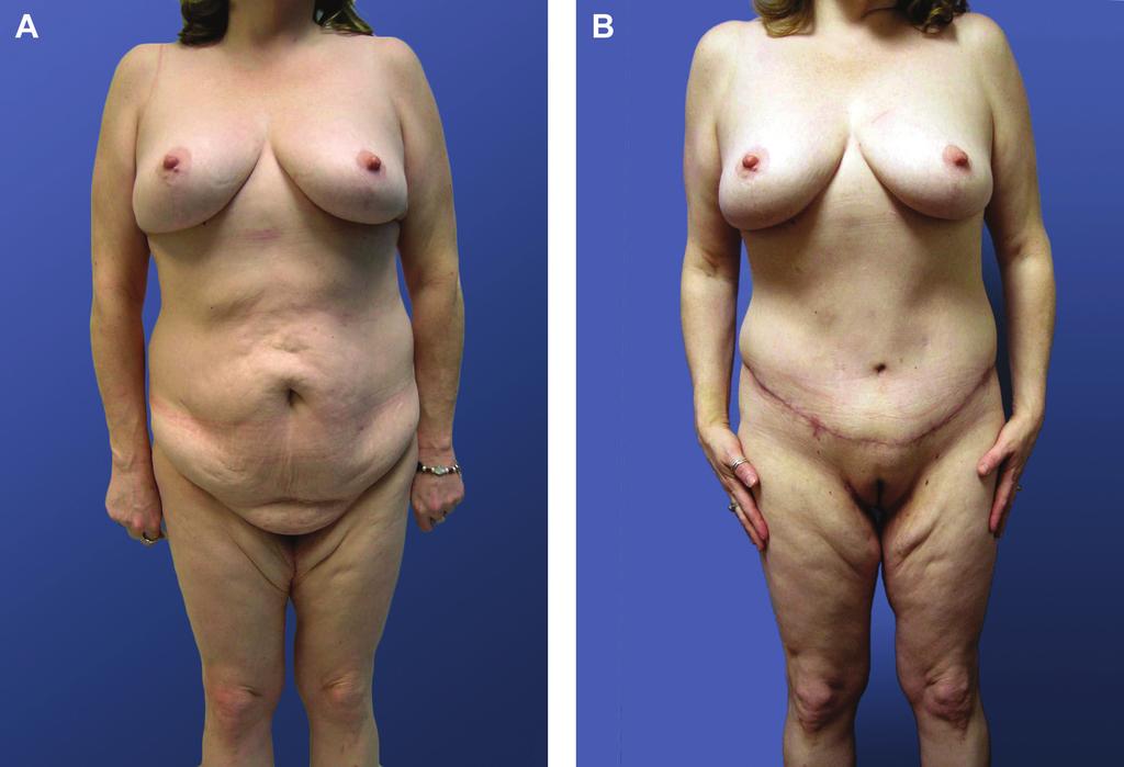 Bloom et al 881 Figure 2. (A) This 43-year-old woman presented with a chief complaint of skin laxity after a 90-lb weight loss following gastric bypass surgery.