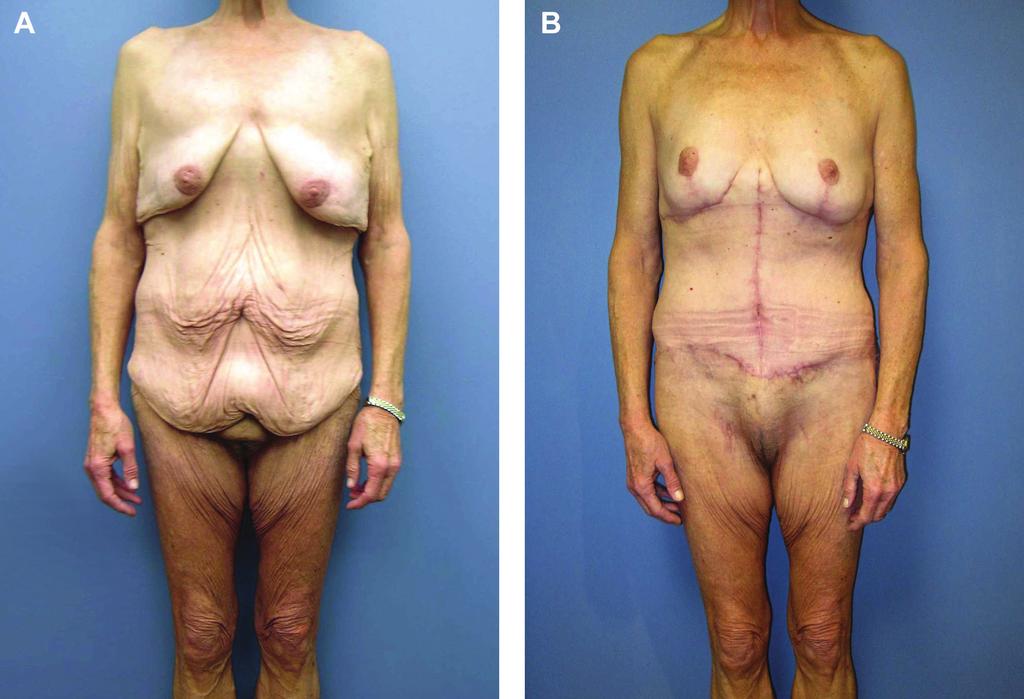 Bloom et al 883 Figure 4. (A) This 63-year-old woman presented with a chief complaint of skin laxity after a 172-lb weight loss following gastric bypass surgery.