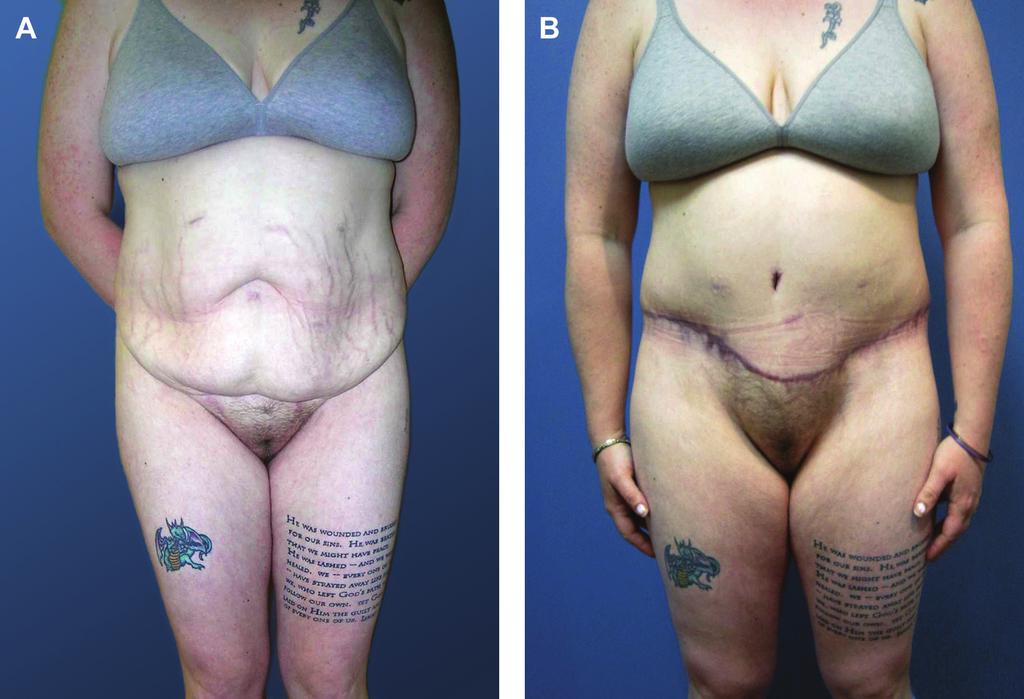 884 Aesthetic Surgery Journal 32(7) Figure 5. (A) This 32-year-old woman presented with a chief complaint of symptomatic pannus after an 87-lb weight loss following gastric bypass surgery.
