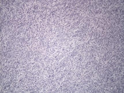 sarcoma Germ cell tumor Multi-lineage