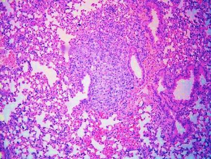 seeded multiple tumor emboli to the lung.