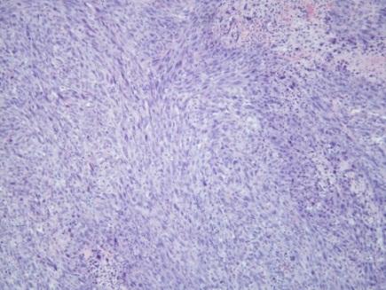 abdominal germ cell tumor, multi-lineage