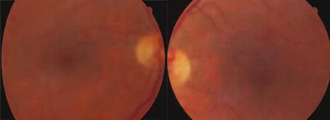The eye fundus exhibited non-specific pigmentary changes at the macular level (fig. 2).
