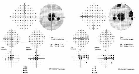 Retinopathy due to chloroquine The AP revealed a reduction of the central and paracentral threshold values in BE (fig. 3).