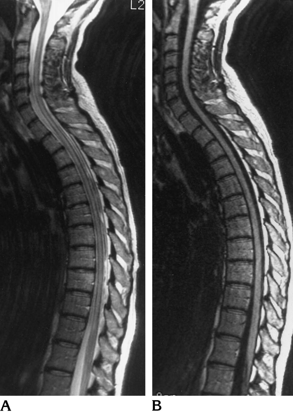 1036 KEIPER AJNR: 18, June 1997 Subjects and Methods Fifteen patients (seven men and eight women) ranging in age from 25 to 64 years with known MS involving the spinal cord and brain by clinical