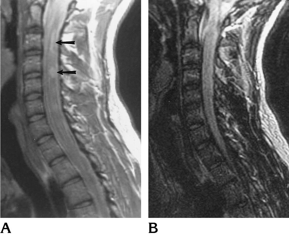 AJNR: 18, June 1997 MULTIPLE SCLEROSIS 1037 Fig 2. A 29-year old man with known cervical spinal cord MS lesions.