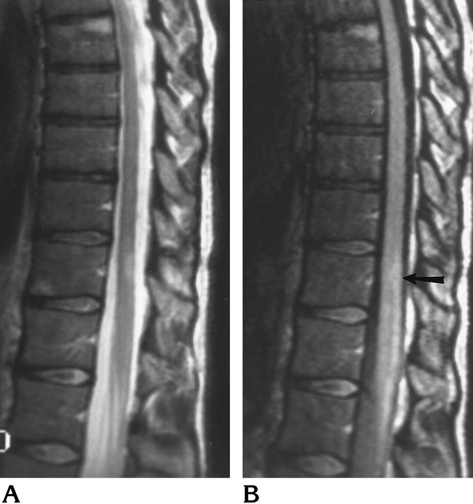 Proton density weighted image clearly shows two MS lesions of the cervical cord (arrows) that are not seen at all on the short-tr/te FLAIR image. MS lesions of the spinal cord.