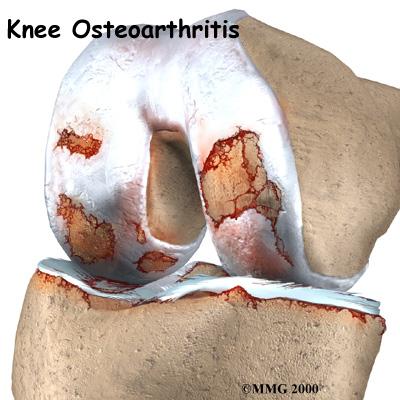 Introduction Osteoarthritis (OA) is a common problem for many people after middle age. OA is sometimes referred to as degenerative, or wear and tear, arthritis. OA commonly affects the knee joint.