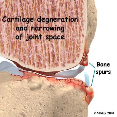 to knee OA. Losing only 10 pounds can reduce the risk of future knee OA by 50 percent. Scientists believe that problems in the subchondral bone may trigger changes in the articular cartilage.