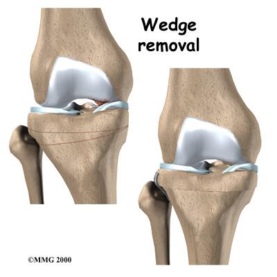 A proper joint angle actually allows the cartilage to regrow, a process called regeneration.