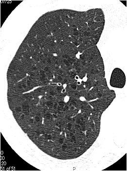 56 The Open Respiratory Medicine Journal, 213, Volume 7 Takahashi et al. a b c Fig. (1). HRCT images of three subtypes. Typical high-resolution CT images in A (a), B (b), and C (c) are shown.
