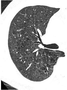 C is defined as emphysema which showed irregular-shaped LAA with ill-defined border coalesced with each other.