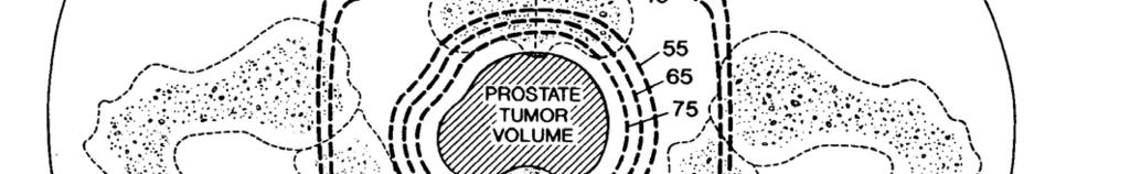 The first use of proton radiation in prostate cancer Four field