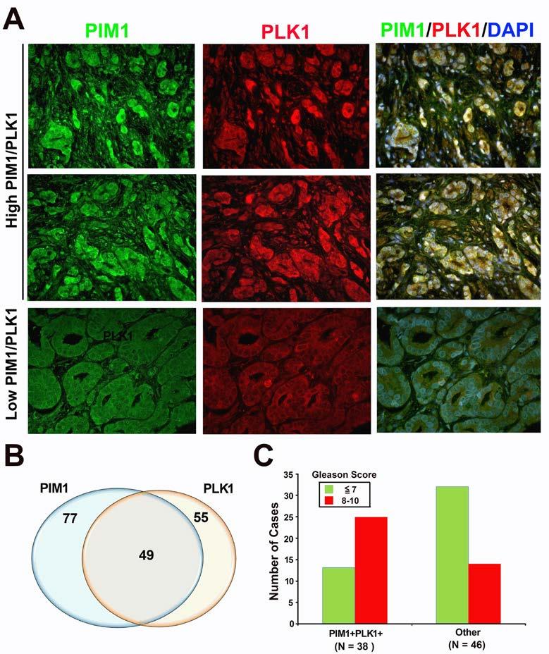 Figure 8. Co-expression of PLK1 and PIM1 in human prostate tumors. A, Representative images showing high expression levels of PIM1 and PLK1 as well as co-localization in human prostate tumors.