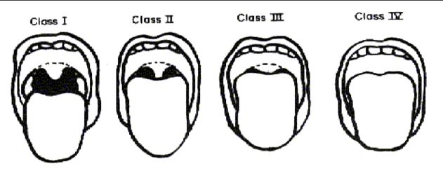 Attachment 3: Airway Anatomy via Mallampati Scale: Mallampati/Samsoon classes are useful to classify patients with varying difficulties of potential airway management and/or intubation.