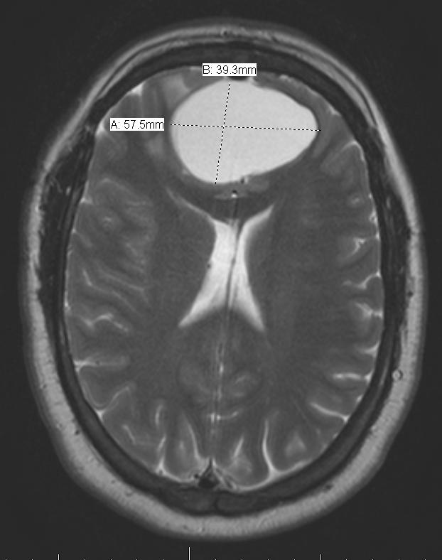 MRI Brain 2012 56 mm x 39 mm x 15