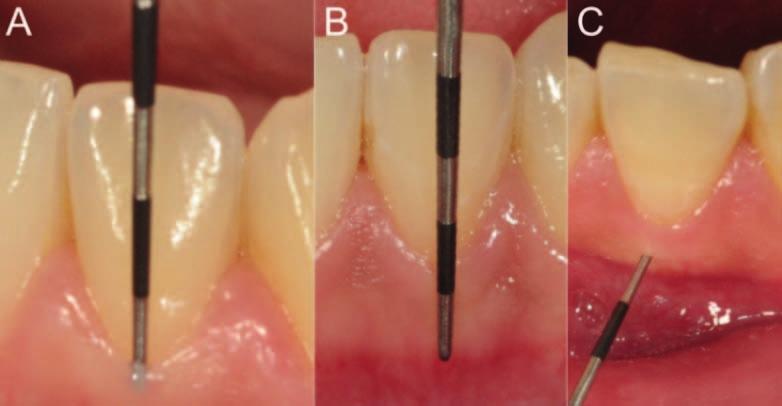 92 PARK, HONG, AHN, KIM Figure 1. Clinicl periodontl soft tissue mesurements. (A) Probing to determine gingivl biotype. (B) Kertinized gingivl width. (C) Kertinized gingivl thickness.
