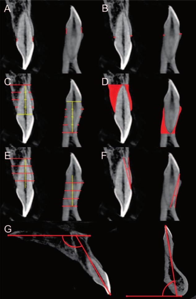 94 PARK, HONG, AHN, KIM gingivl width (P,.05) nd kertinized gingivl thickness (P,.001). Lingul plte fctor ws not significntly correlted with ny soft tissue prmeters.