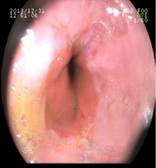 Figure 4: Follow up endoscopy shows normal esophagus Discussion Boerhaave s syndrome is an emergency wherein there is a spontaneous rupture of the esophagus, in the lower third of the left