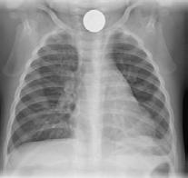 Chest Tube Placement (Chest X-ray: Tubes- chest drains-position, 2017) Case