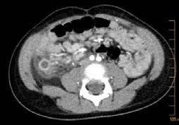 Appendicitis Case Scenario 4 5 week old male presents with vomiting History PMHx Vital