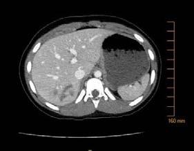 TRAUMA RADIOGRAPHS MEDICAL DEVICES AAST Liver Trauma Classification Grade I: Subcapsular hematoma <10% surface area, capsular tear <1cm Grade II: Subcapsular hematoma 10-50% surface area, capsular