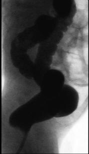 Contrast Enema Used to evaluate for: Hirschprung disease Strictures or