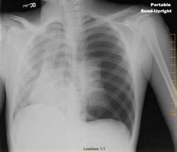 Pneumothorax Case Progression What are your interventions?