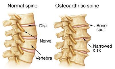Neck Arthritis Also called Cervical spondylosis Caused by degeneration of the discs or cushions between