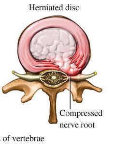 Herniated Lumbar Disk Commonly called Sciatica The disks in between the vertebral bodies herniates and compresses nerve