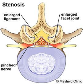 Lumbar Spinal Stenosis Degeneration and narrowing of the levels between the