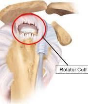 Rotator Cuff Tear Occurs when tendon is torn away from the bone Can happen traumatically or gradually over time