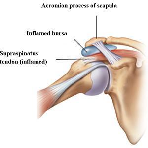 Impingement Commonly called bursitis or rotator cuff tendonitis The space where the rotator cuff tendon lives is narrow Repeated pinching of tendon between bones leads