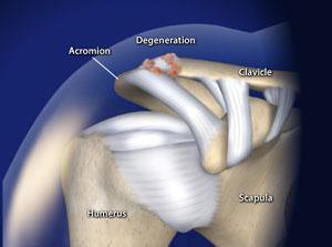 AC Arthritis The joint between the shoulder blade and the collar bone is called the Acromialclavicular joint or AC joint It is the only bony articulation between the arm