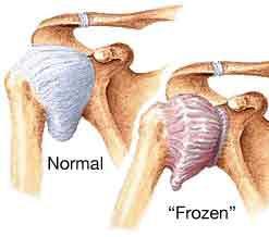 Frozen Shoulder Medical term is adhesive capsulitis Can be due to acute injury but in most cases cause is unknown