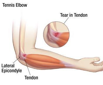 Tennis Elbow Lateral epicondylitis Pain on outside part of elbow gradual onset, rarely sudden worse