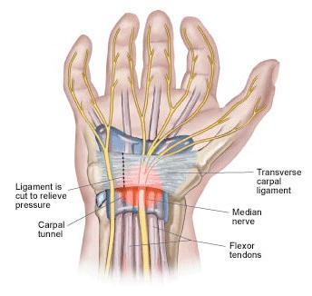 Carpal Tunnel Syndrome Compression of the median nerve at the wrist Most commonly affect middle-aged and pregnant women Present