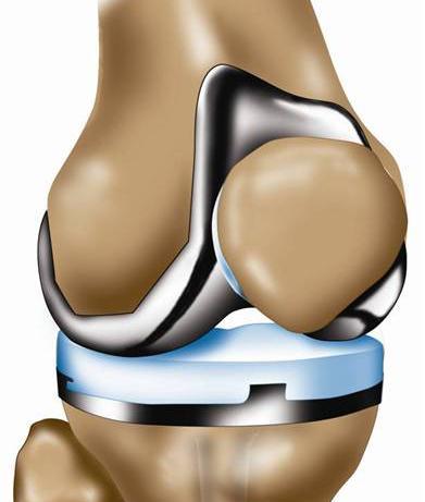 Knee Osteoarthritis If all other treatments fail and pain persists and