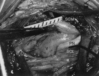 Surgical Procedure (cont.) 2. Assisted by monopolar electrical stimulation, the phrenic nerve is identified over the scalene muscle. 3.