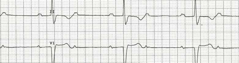 Atrial Rate Vent. Rate Reg Irreg PRI QRS 2. What are three nursing interventions that Bob should perform to care for Jim?