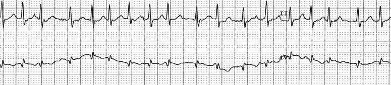 Part A: analyze and interpret the following rhythm strips 1. Atrial Rate Vent.