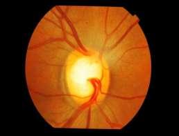 (iv) Glaucomatous
