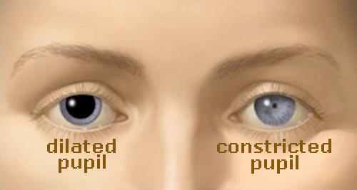 Dilated Eye