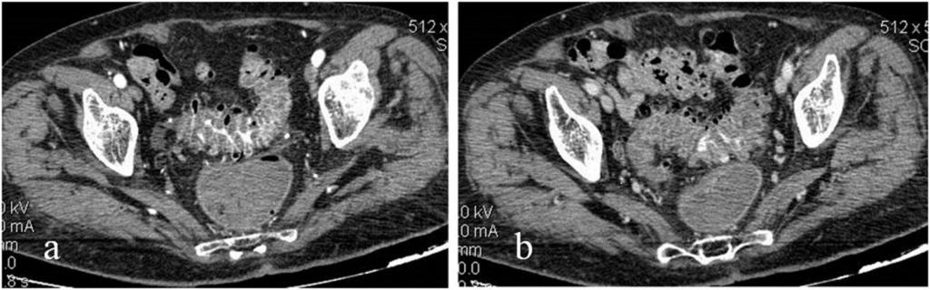 Fig. 1: Active left colonic diverticular bleeding in a 93-year-old woman who was on anticoagulant therapy.