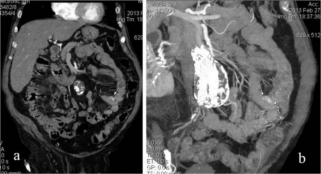 Fig. 3: 78-year-old man with small bowel angiodysplasia. Oblique MPR [a] and MIP [b] images from arterial phase show a nodular contrast enhancement of the small bowel wall (arrows).